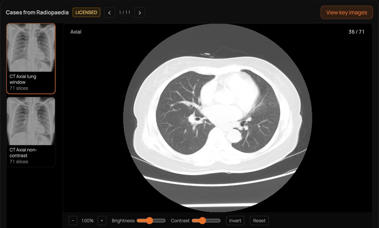 MyRadAssistant's licensed Radiopaedia case viewer from the same answer, showing an axial chest CT in lung window, slice 36 of 71