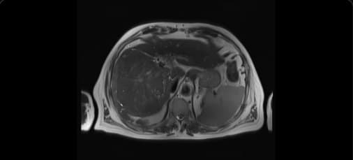 MRI: hepatocellular carcinoma