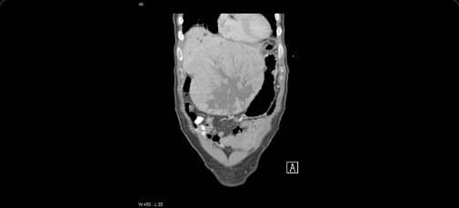 Coronal CT: hepatocellular carcinoma
