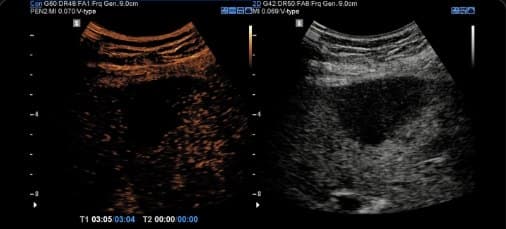 Contrast ultrasound: recurrent hepatocellular carcinoma