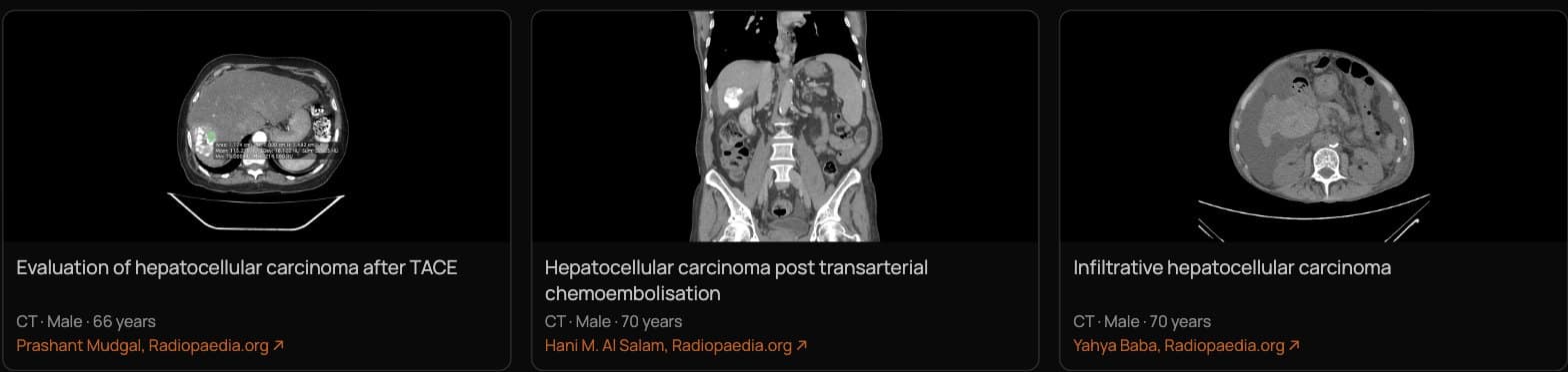 Case Search results for hepatocellular carcinoma after TACE, each credited to its Radiopaedia author